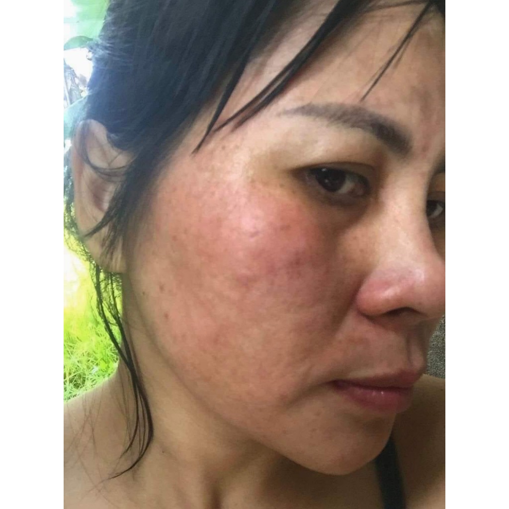 Cao nám Melasma,cao nám tuyết hoa Hammy skin -Chính hãng giảm thâm,mờ nám, tàn nhang dưỡng da căng bóng hiệu quả .