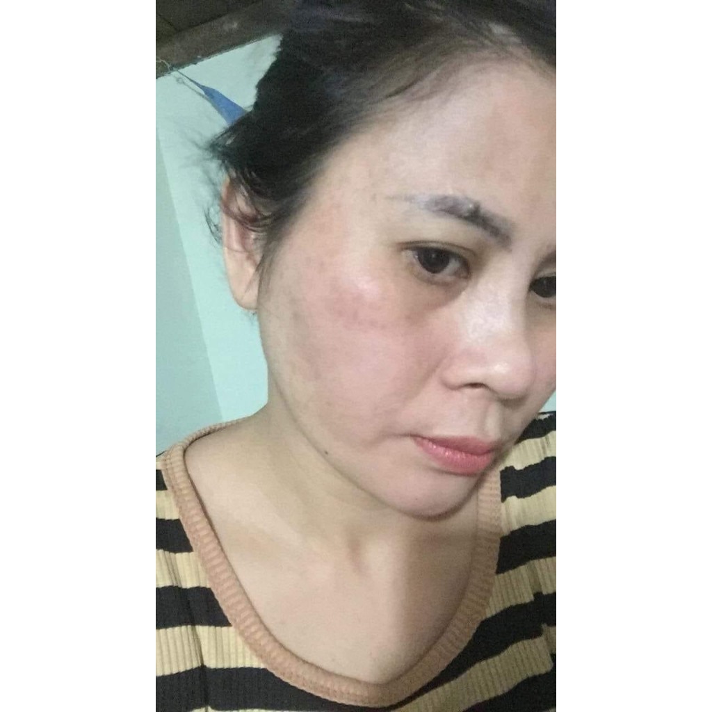 Cao nám Melasma,cao nám tuyết hoa Hammy skin -Chính hãng giảm thâm,mờ nám, tàn nhang dưỡng da căng bóng hiệu quả .