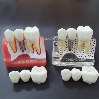 Hàm tư vấn so sánh cầu răng và implant trong Nha khoa