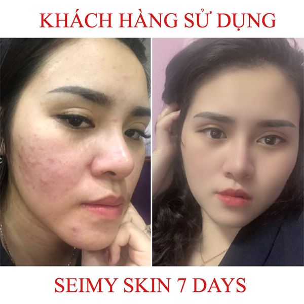 Seimy - Skin 7 Days Serum giảm mụn thâm rỗ công dụng sau 7 ngày