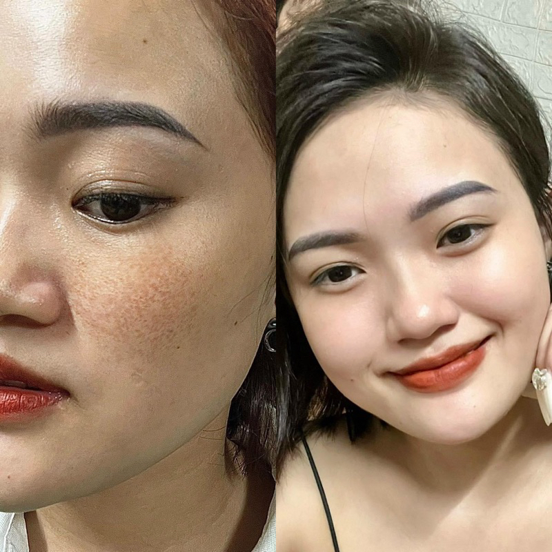Serum Ampoule Xoá Nám Không Xâm Lấn MOOSE+ Hàn Quốc