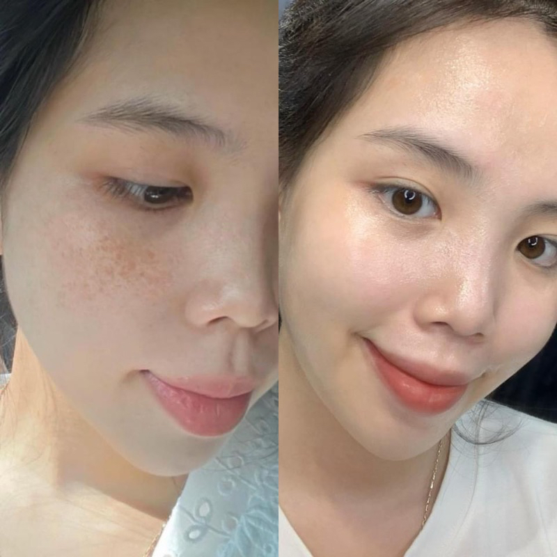 Serum Ampoule Xoá Nám Không Xâm Lấn MOOSE+ Hàn Quốc