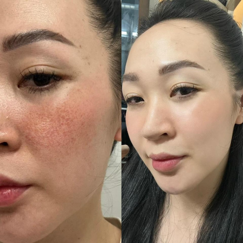 Serum Ampoule Xoá Nám Không Xâm Lấn MOOSE+ Hàn Quốc