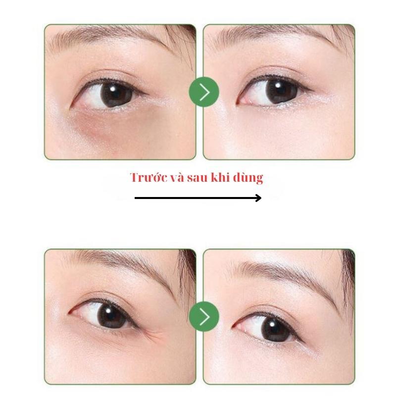 Kem mụn thịt liti dưỡng ẩm mắt Yakino săn chắc mắt, bọng mắt mờ nếp nhăn,quầng thâm - kem bơ giảm mụn thịt