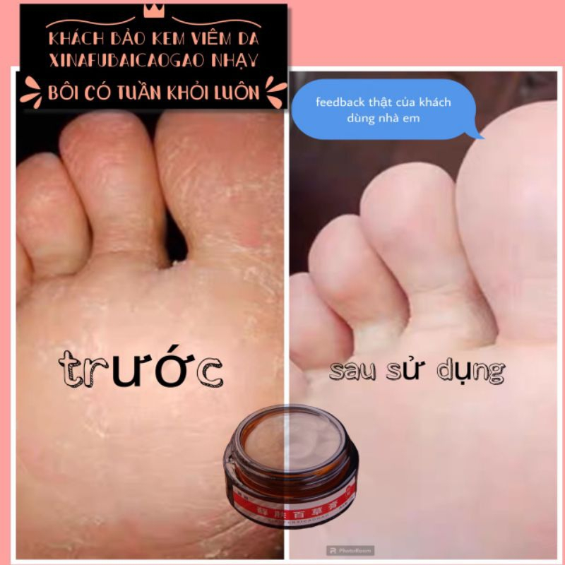 Kem Bôi Viêm Da Cơ Địa Đông Y XIAFUBAICAOGAO - Làm Dịu Da, Giảm Khô Ngứa, Chàm, Ghẻ, Á Sừng