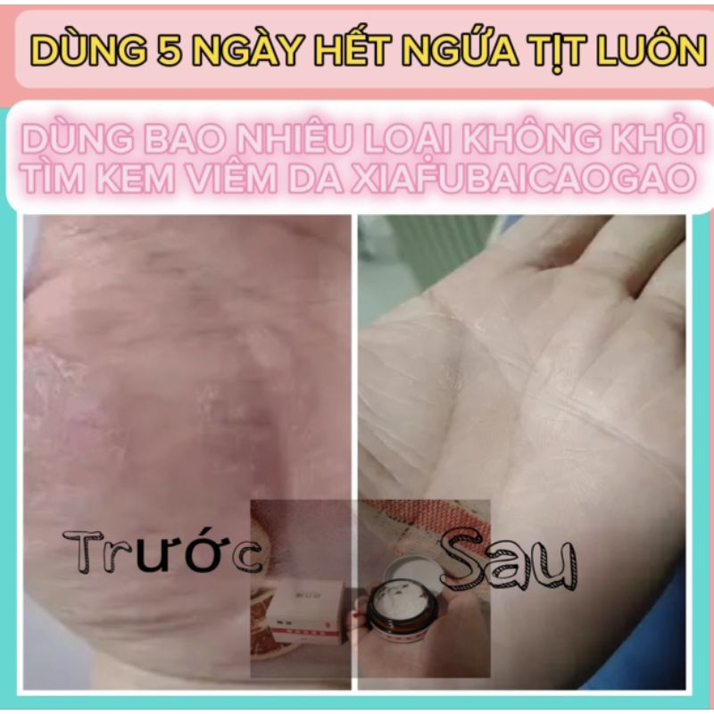 Kem Bôi Viêm Da Cơ Địa Đông Y XIAFUBAICAOGAO - Làm Dịu Da, Giảm Khô Ngứa, Chàm, Ghẻ, Á Sừng