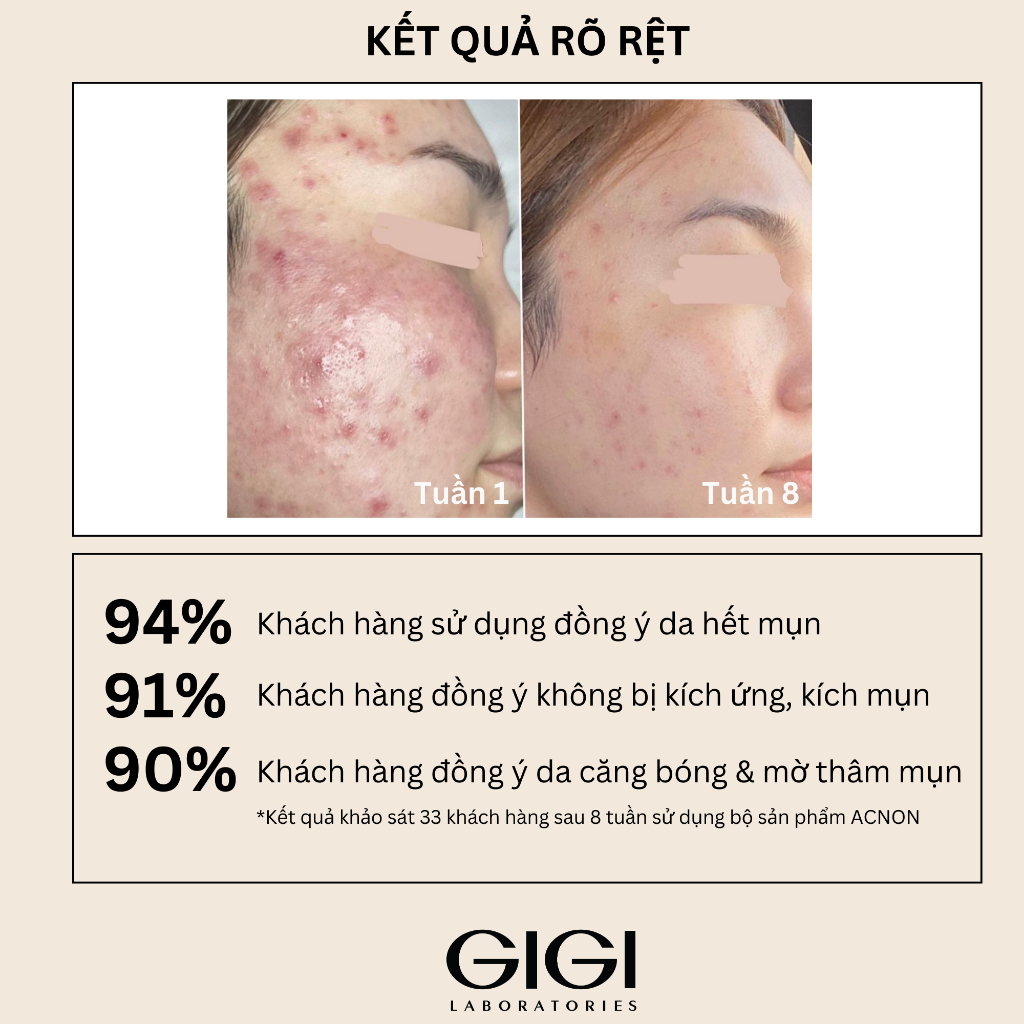 Kem dưỡng ban đêm dành cho da dầu mụn GIGI ACNON OVERNIGHT TREATMENT 50ml