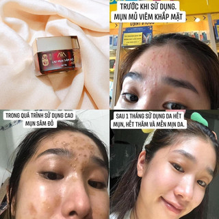 CAO MỤN SÂM ĐỎ - 36 VỊ ĐÔNG Y 15GR (MUA 2HOP ĐÃ ĐƯỢC GIÁ SĨ)