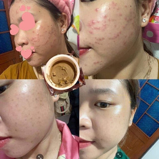 CAO MỤN SÂM ĐỎ - 36 VỊ ĐÔNG Y 15GR (MUA 2HOP ĐÃ ĐƯỢC GIÁ SĨ)