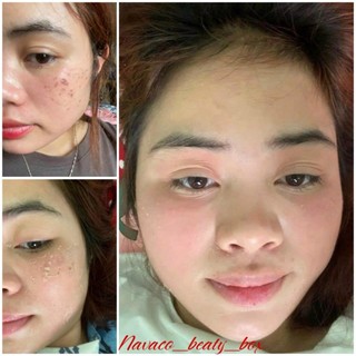 Navo Peel 2 (Mẫu mới - 3 lọ x 30ml)