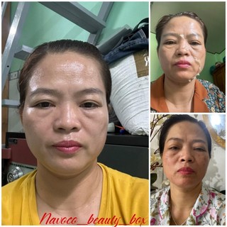 Navo Peel 2 (Mẫu mới - 3 lọ x 30ml)