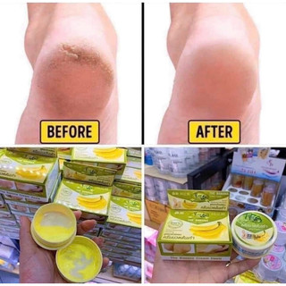 Kem nứt gót chân thái lan nứt gót chân chuối kem dưỡng gót chân nứt Kem làm mềm gót chân nứt nẻ