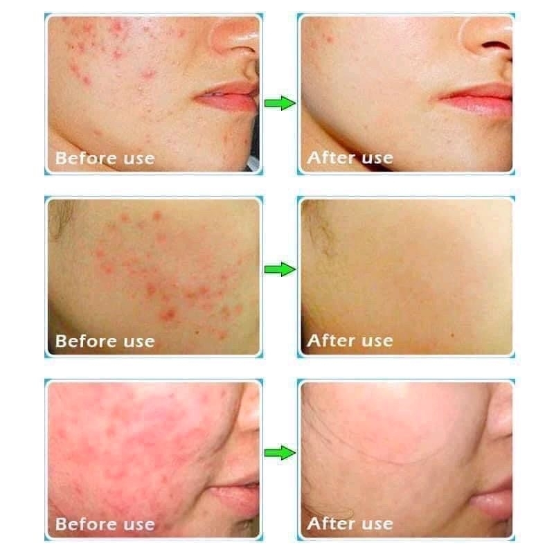 SKINOREN- ACID AZELAIC 20% giảm mụn mờ thâm nám tuýp 30g bản Italya  Chính Hãng