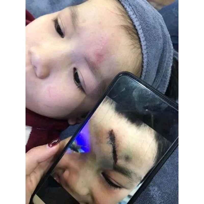 Cao Xoá Sẹo Collagen Mờ Sẹo Lồi Lõm Giúp Nhanh Lành Vết Thương Không Để Lại Sẹo