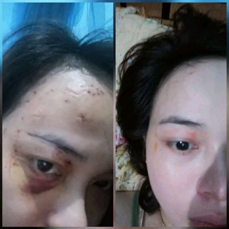 Cao Xoá Sẹo Collagen Mờ Sẹo Lồi Lõm Giúp Nhanh Lành Vết Thương Không Để Lại Sẹo