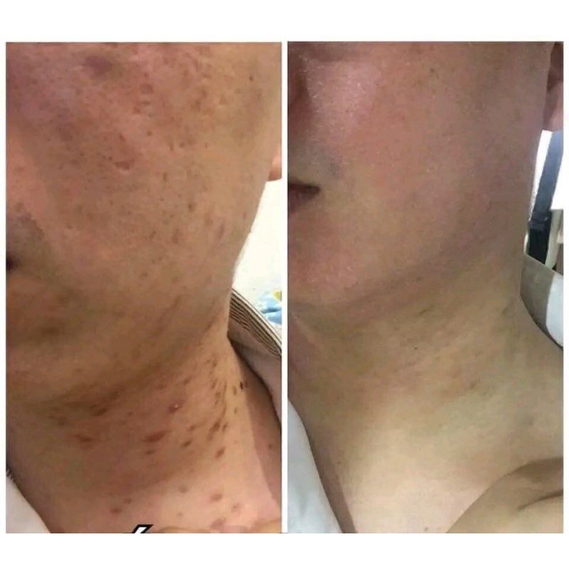 Cao Xoá Sẹo Collagen Mờ Sẹo Lồi Lõm Giúp Nhanh Lành Vết Thương Không Để Lại Sẹo