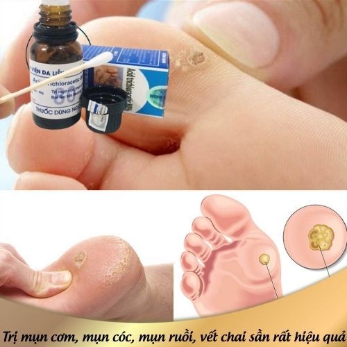 Tẩy mụn cơm, mụn cóc, vết chai sần, tẩy nốt ruồi viện da liễu