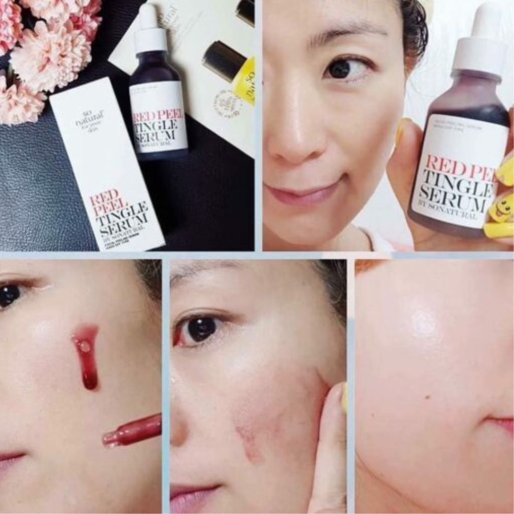 Tinh Chất Tẩy Da Chết Hóa Học So' Natural Red Peel Tingle Serum 11ml