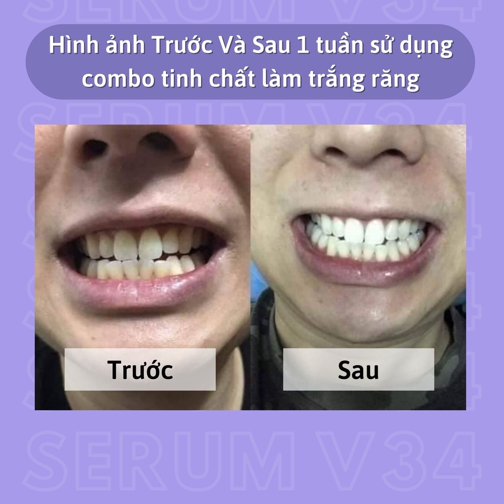 Serum trắng răng V34 SMILEKIT, Tinh chất trắng răng giúp trắng răng tự nhiên, an toàn, không ê buốt - Lọ 30ml - UNIFA