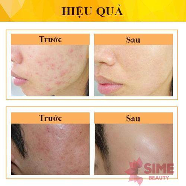 Kem Mờ Thâm Mụn Gamma Derma Forte Giảm Sưng Đỏ 15g
