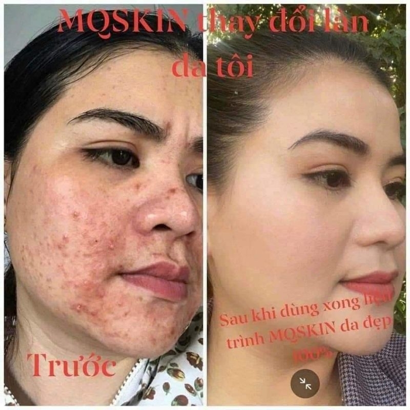 Kem BB MQ, tái tạo BB MQ chính hãng