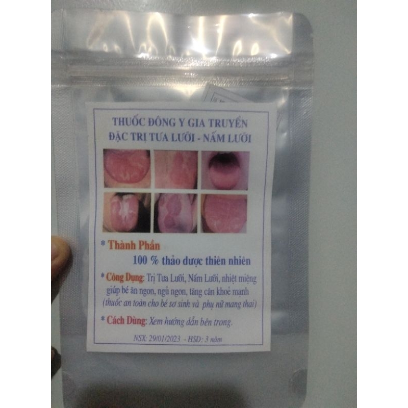 Nấm lưỡi, tưa lưỡi