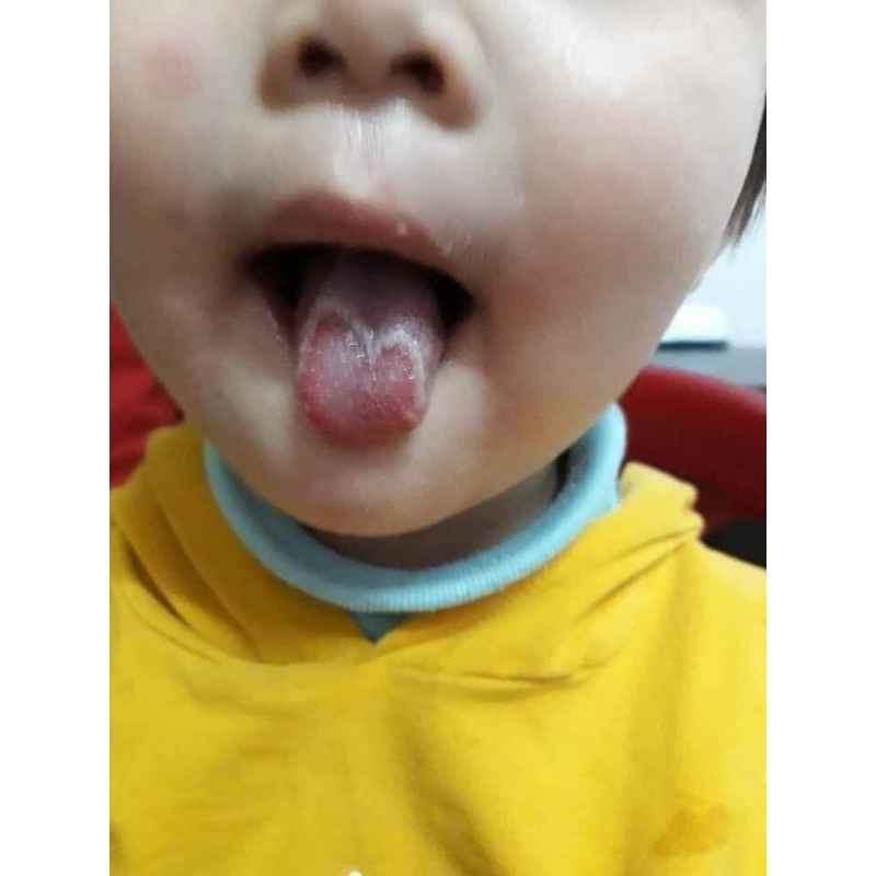 Nấm lưỡi, tưa lưỡi