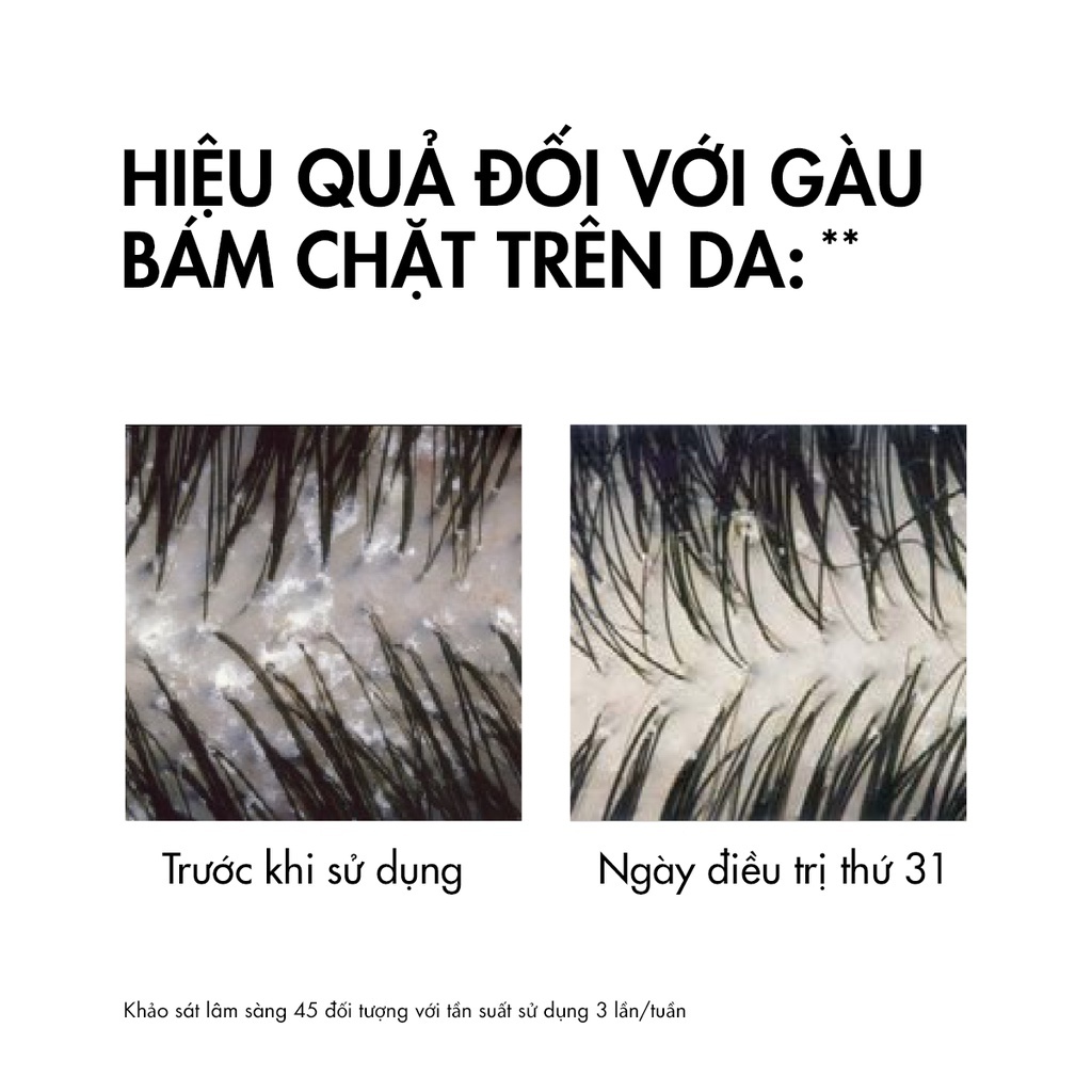 Dầu Gội Vichy Dercos Anti Dandruff Sạch Gàu Cho Da Đầu Dầu, Ngứa 200ml