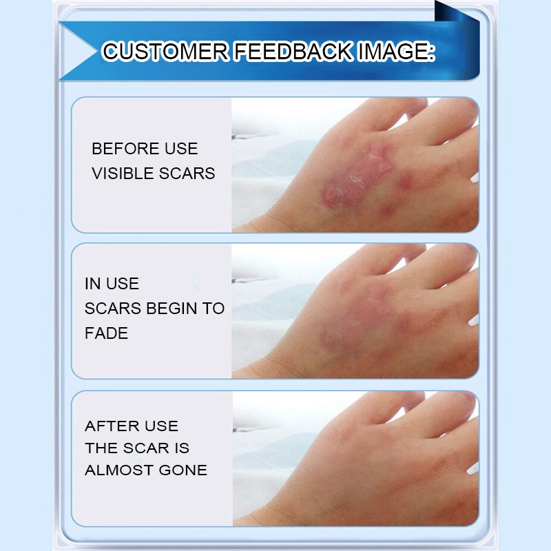 Scar Cream Scar Removal Kem sẹo sẹo lồi Loại bỏ sẹo Vết rạn da Làm mịn da Sửa chữa vết thương Vết sẹo phẫu thuật