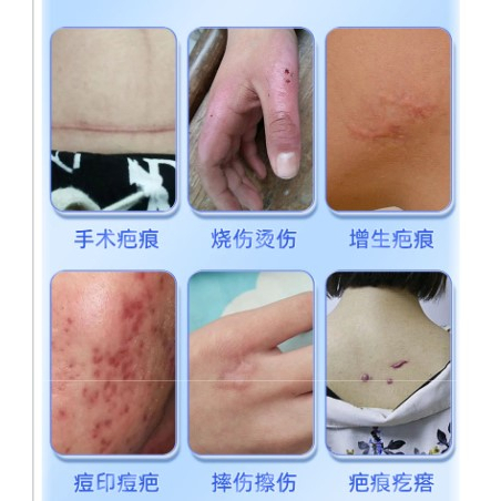 Kem tẩy sẹo 20g Bỏng Vết rạn da Cơ thể Mặt Sẹo Sửa chữa Gel Làm mịn da Sửa chữa vết thương