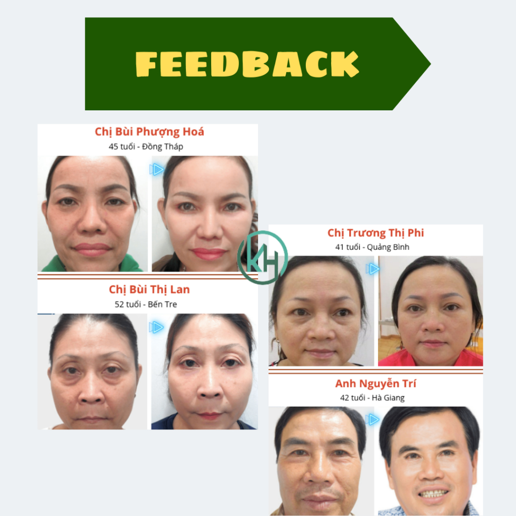 Tinh chất lăn bọng mắt LOY HANC, thanh lăn bọng mắt LOY HANC, serum làm đầy rãnh nhăn, cải thiện quầng thâm mắt 20ml