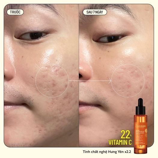 TRIAL SIZE - Tinh chất nghệ Hưng Yên x2.2 (serum) với 22% vitamin C sáng da chuyên sâu & mờ vết thâm Cocoon 5ml