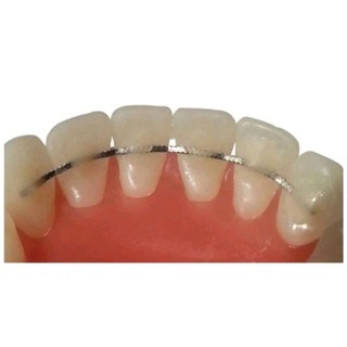 Thanh duy trì cố định sau chỉnh nha/ túi 2 dây hàm trên dưới thanh dẹt _ thanh xoắn