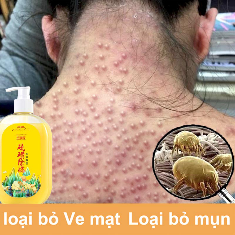 ⚡⚡sữa tắm mụn lưng sữa tắm viêm nang lông 400ML Làm sạch sâu bụi bẩn dưới da Cải thiện mụn trứn
