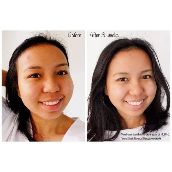 Tinh chất tái tạo trẻ hoá da MURAD Retinol Youth Renewal Serum giúp xóa tan các các nếp nhăn làm sáng da