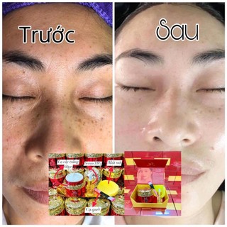 Cấy trắng Lụa . Cấy Trắng Mask Lụa Hoàng Gia