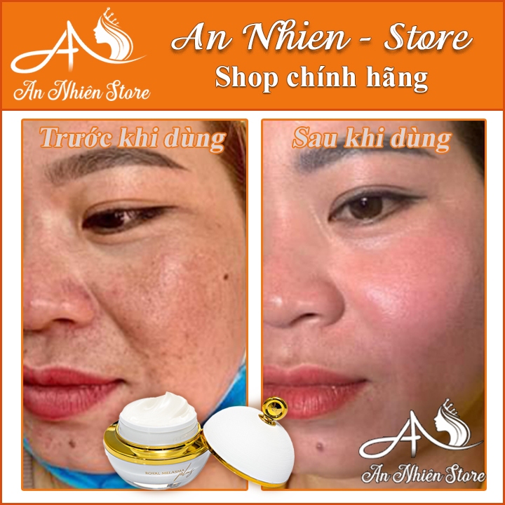 Cao Nám Hoàng Cung mờ nám hiệu quả ,tái tạo tế bào da, mềm mịn,trắng sáng 💖💖– Royal Melasma Plus