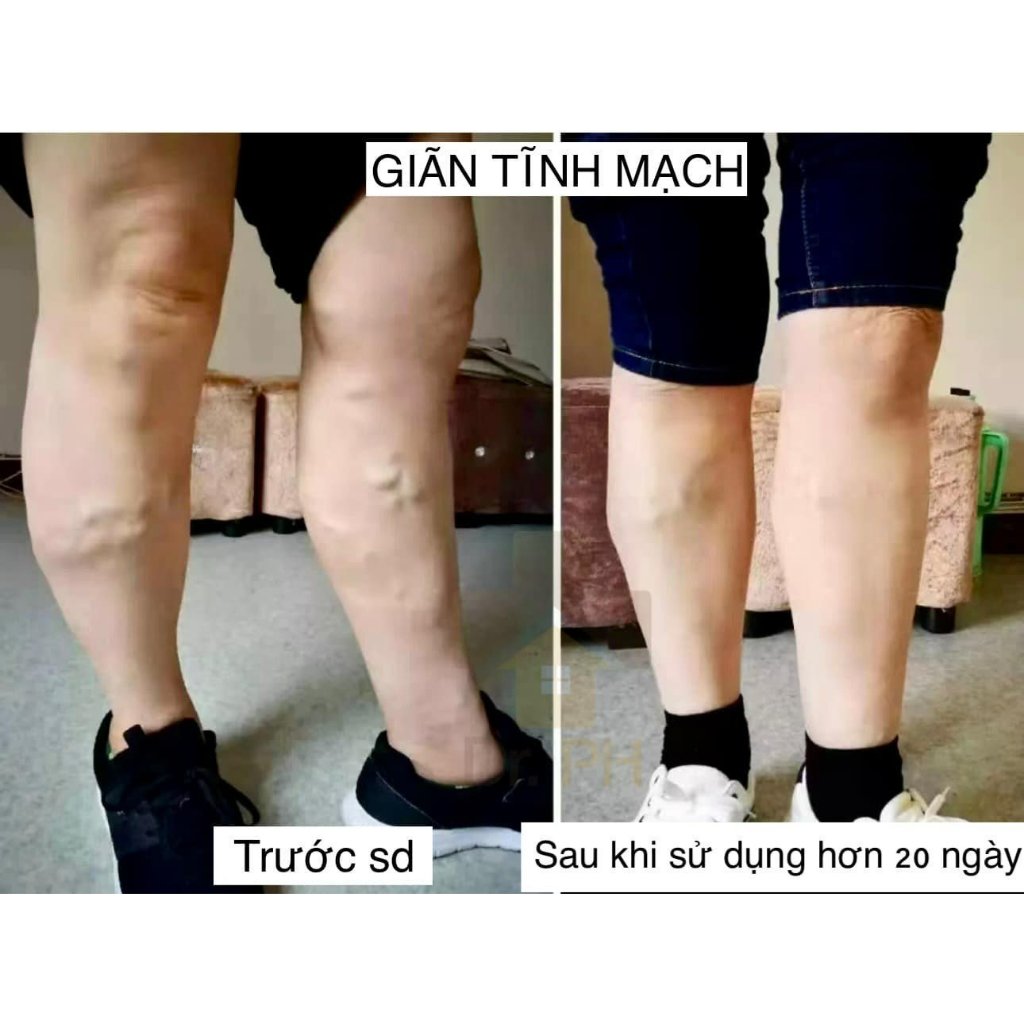 Gel Giãn Tĩnh Mạch.