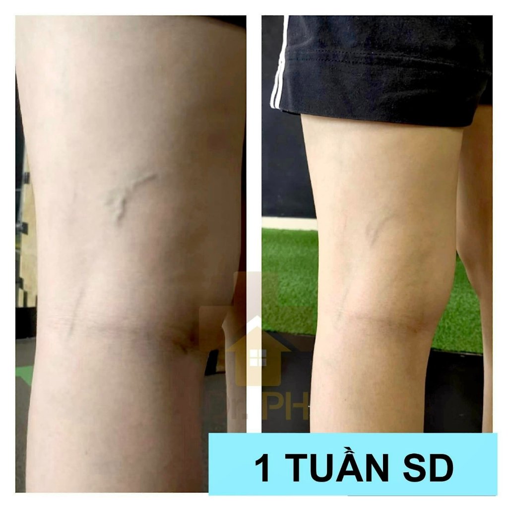 Gel Giãn Tĩnh Mạch.