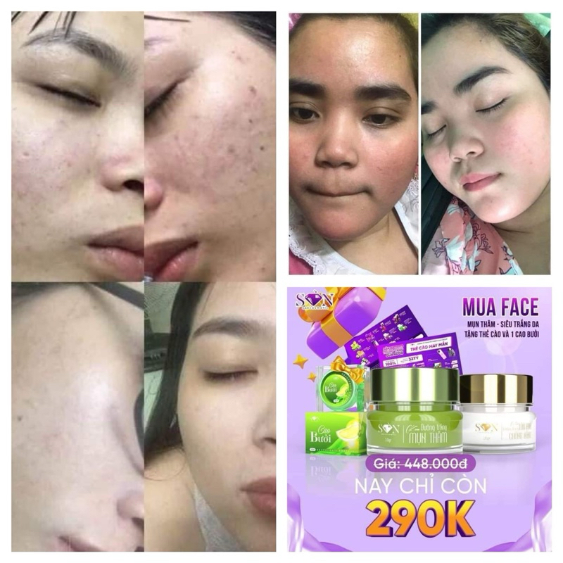 Combo Kem Face Son Nguyễn Tiên Chính Hãng Kèm Thẻ Cào