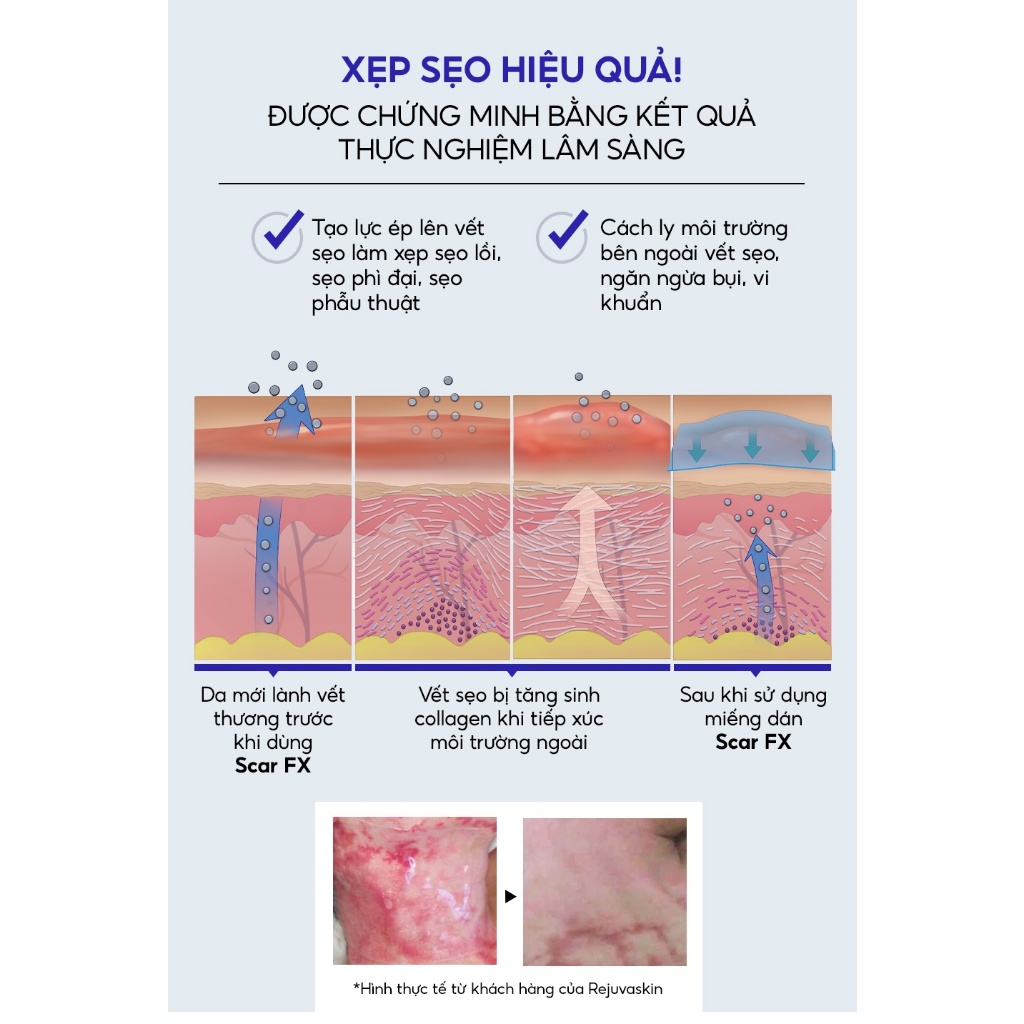 Miếng Dán Sẹo Lồi / Phì Đại REJUVASKIN Scar FX 3.75cm x 7.5cm