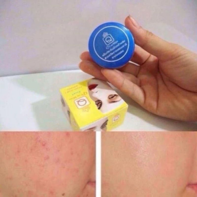 Kem nghệ Q care thái lan chính hãng
