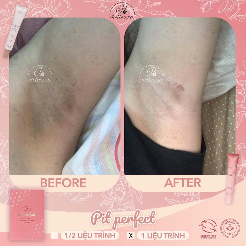 Thâm Nách - Thâm Bẹn