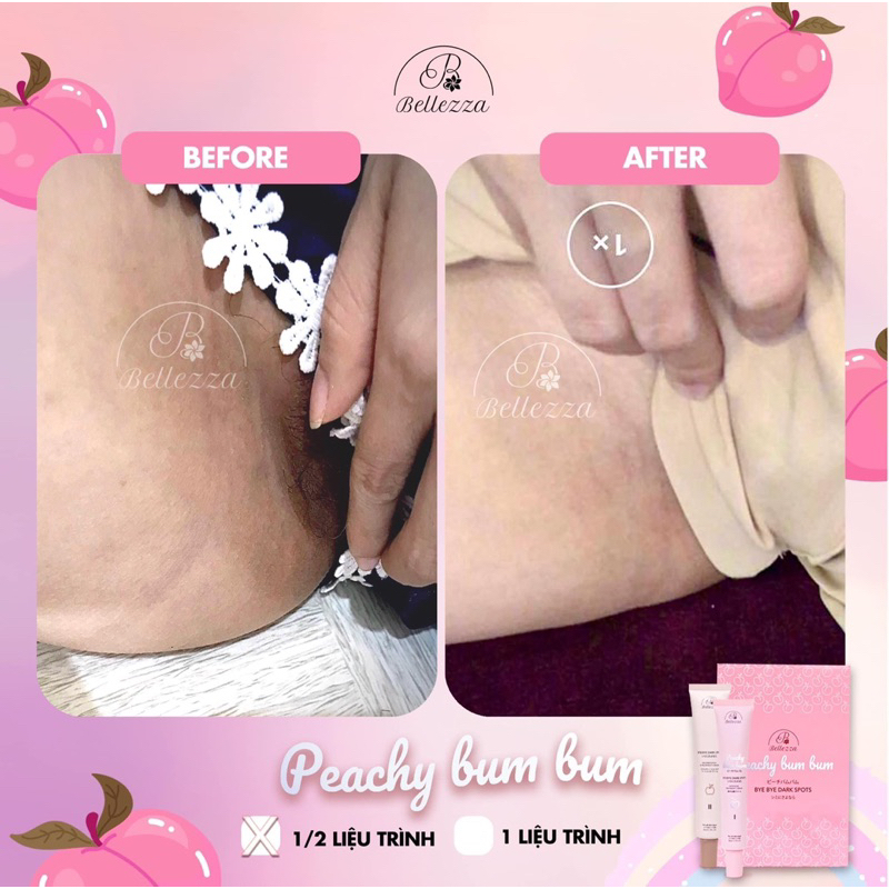 Thâm Nách - Thâm Bẹn