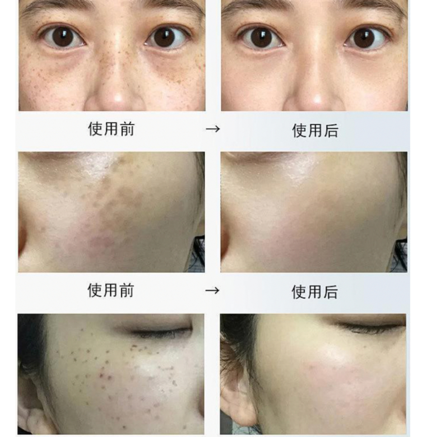 Kem bôi đồi mồi thảo dược Dr.Li - Kem bôi nám, tàn nhang, đồi mồi cho tay và mặt Dr.Li, dưỡng da trắng sáng