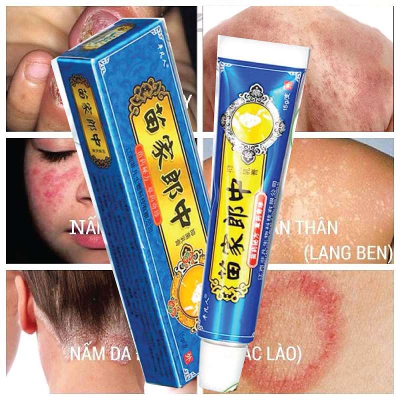 Kem Bôi Nấm Xanh - Kem Bôi Ngoài Da