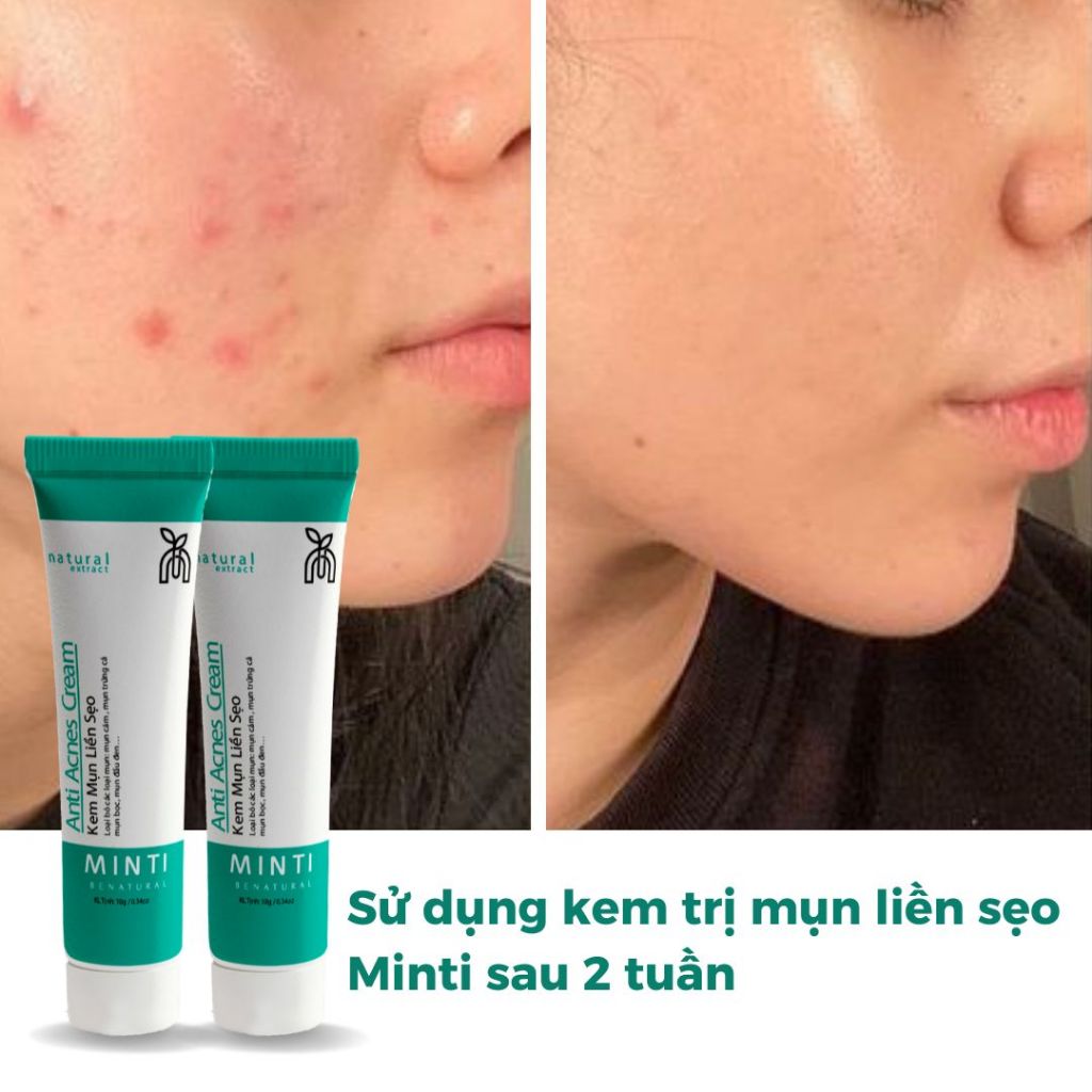 Kem mụn gom cồi - mờ thâm liền sẹo MINTI Be Natural - An toàn lành tính phù hợp mọi loại da