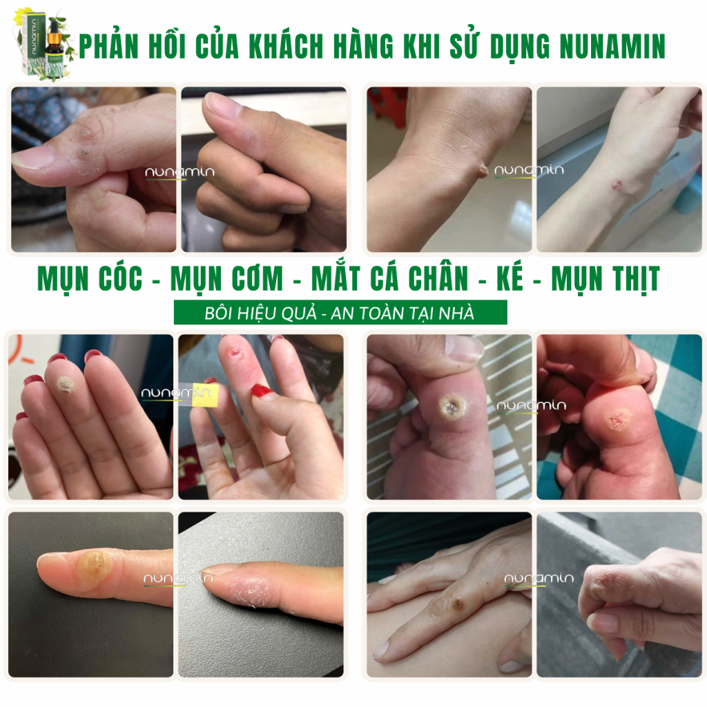 Tinh Chất Chấm Mụn Cóc, Mụn Thịt, Mắt Cá Chân Lâu Năm Nunamin 15 ML + Tặng Băng Gâu X2