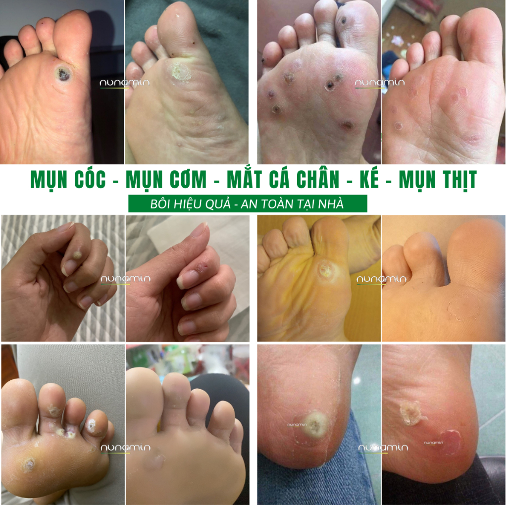 Tinh Chất Chấm Mụn Cóc, Mụn Thịt, Mắt Cá Chân Lâu Năm Nunamin 15 ML + Tặng Băng Gâu X2