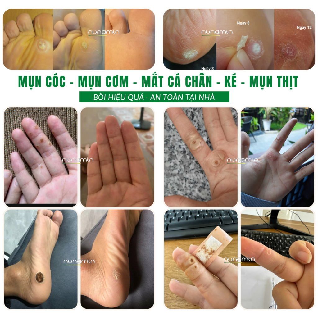 Tinh Chất Chấm Mụn Cóc, Mụn Thịt, Mắt Cá Chân Lâu Năm Nunamin 15 ML + Tặng Băng Gâu X2